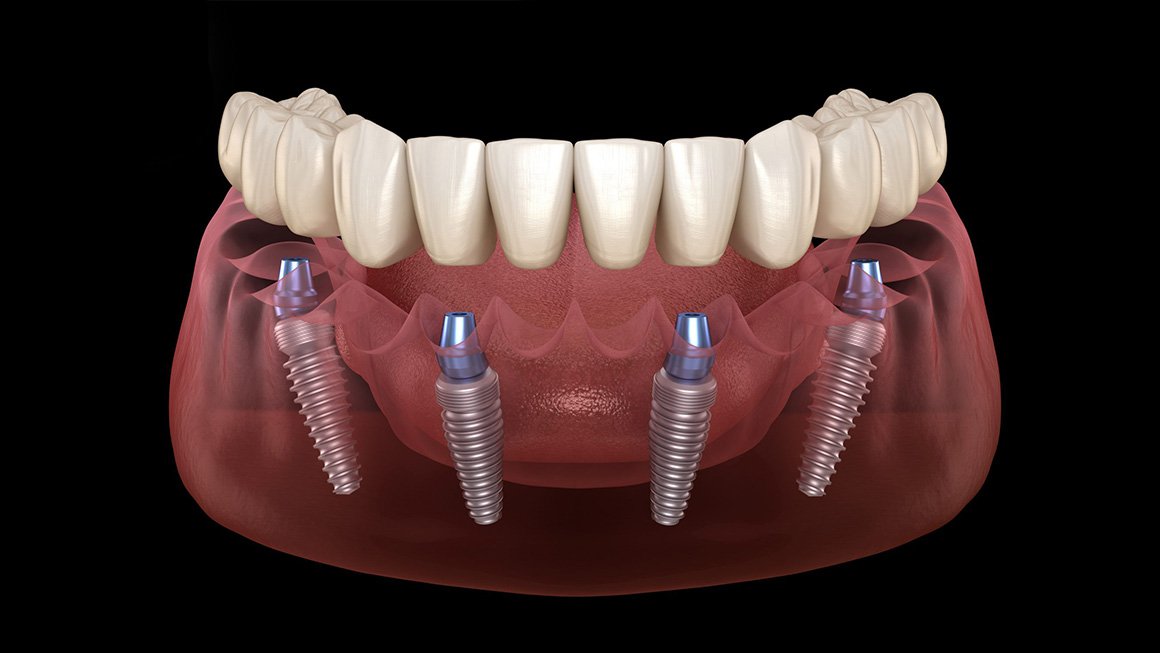 Titanium dental implant treatment