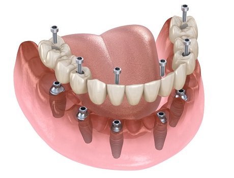 Titanium dental implant treatment planning