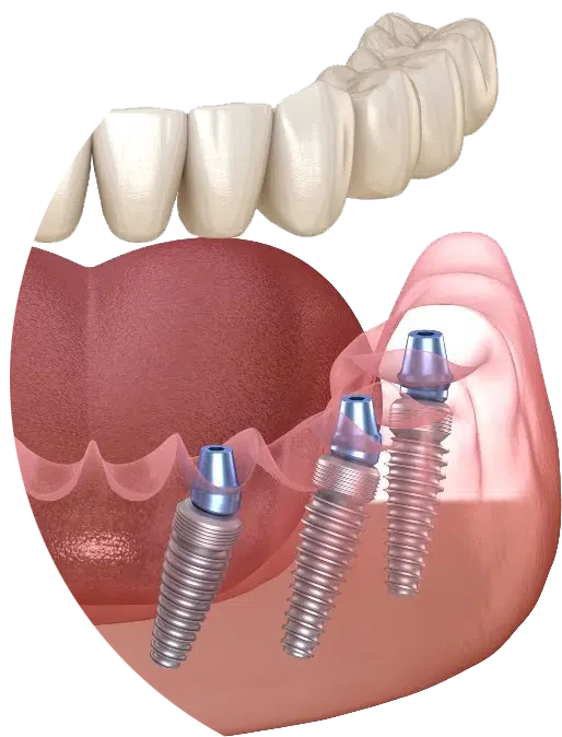 All-on-6 implants supporting a full arch bridge