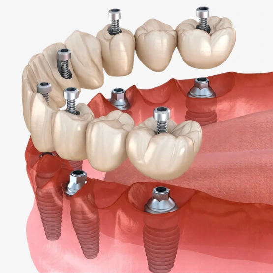 All-on-6 implant supported restoration