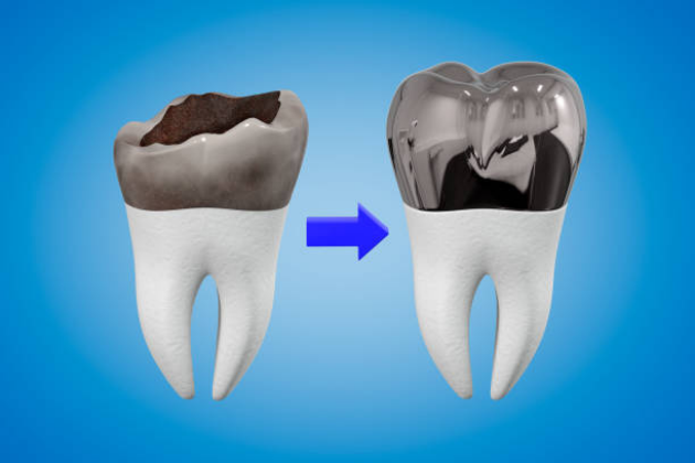 Dental crown restorative treatment