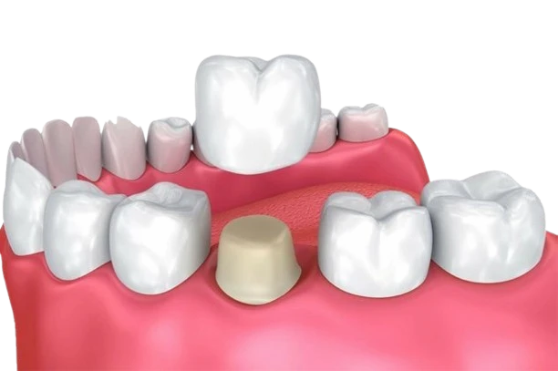 Dental crown restoration illustration