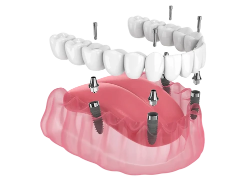 All-on-4 dental implant treatment