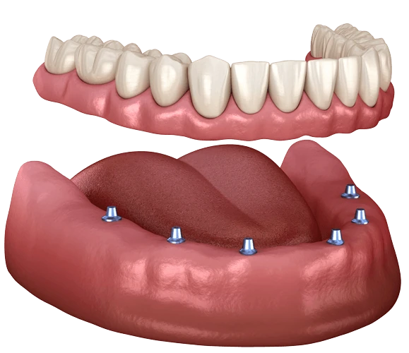 All-on-6 dental implant treatment
