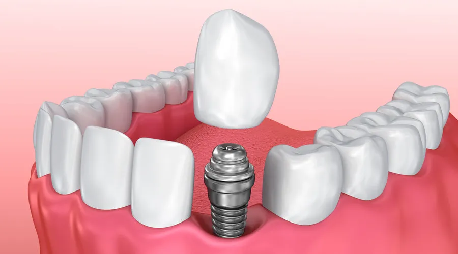 Single and multiple dental implants