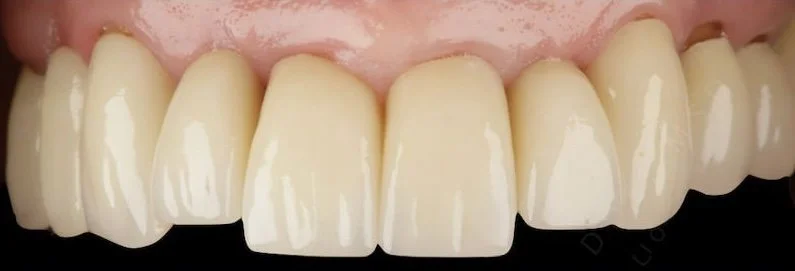 Dental implant case after treatment