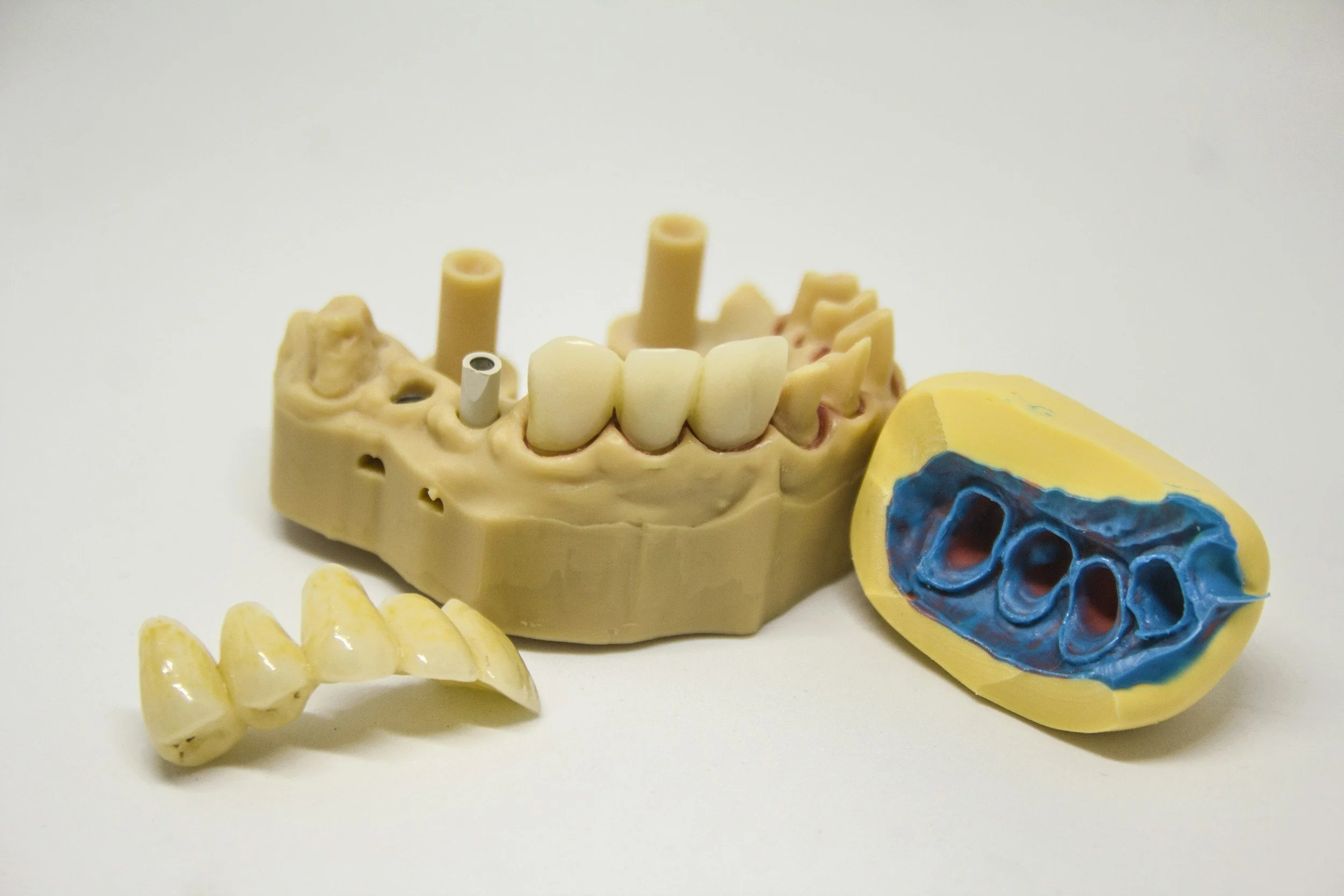 All-on-6 dental implant treatment