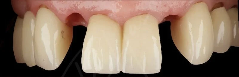 Dental implant case before treatment