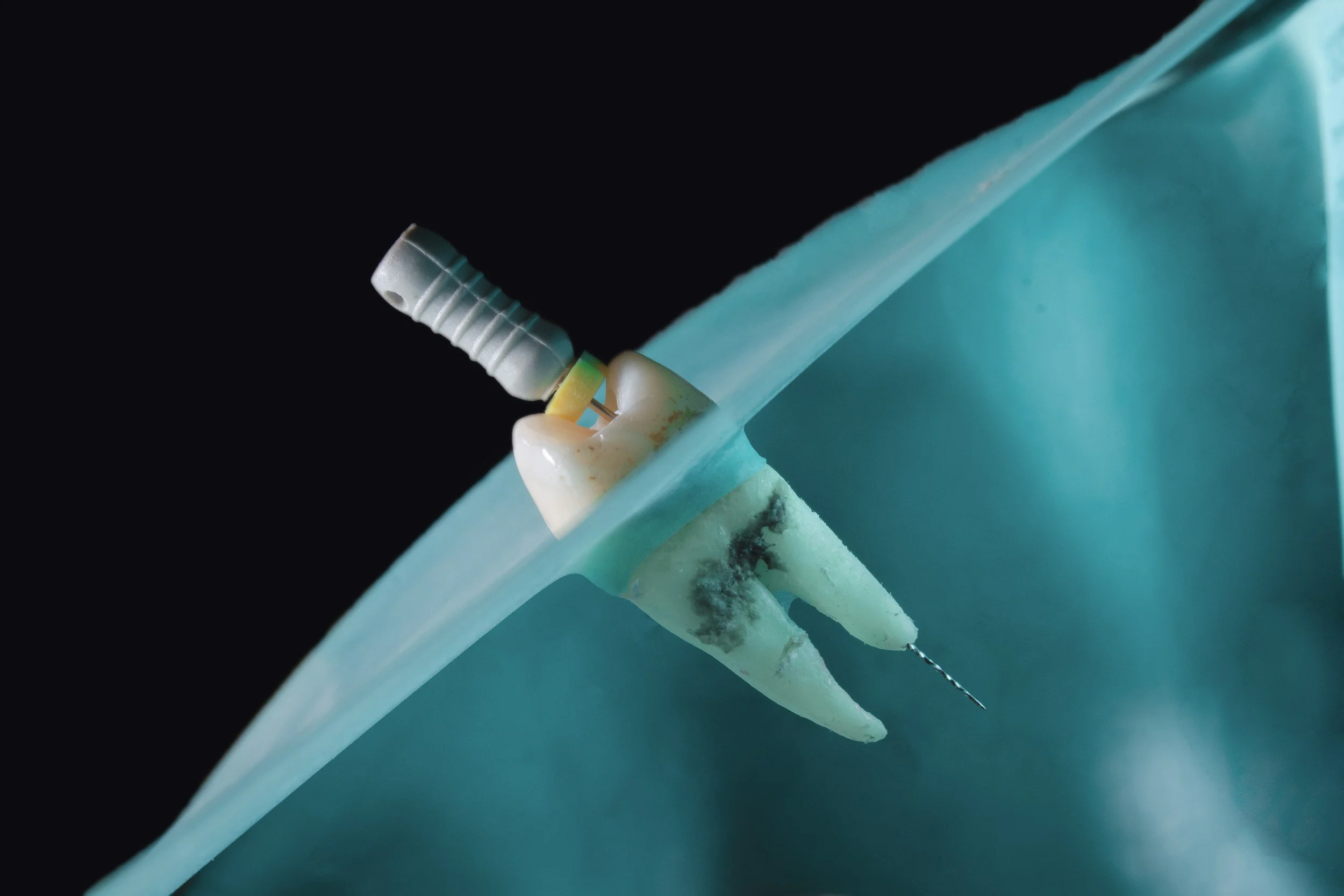 Single dental implant