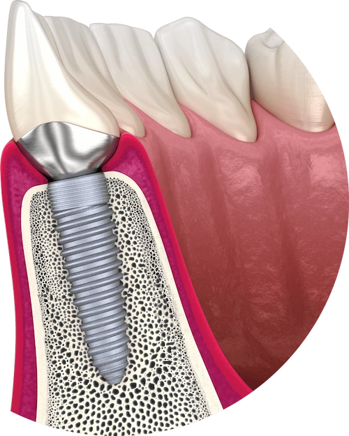 Full arch dental implant rehabilitation