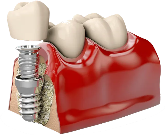 Why Titanium Dental Implants Are the Best Option