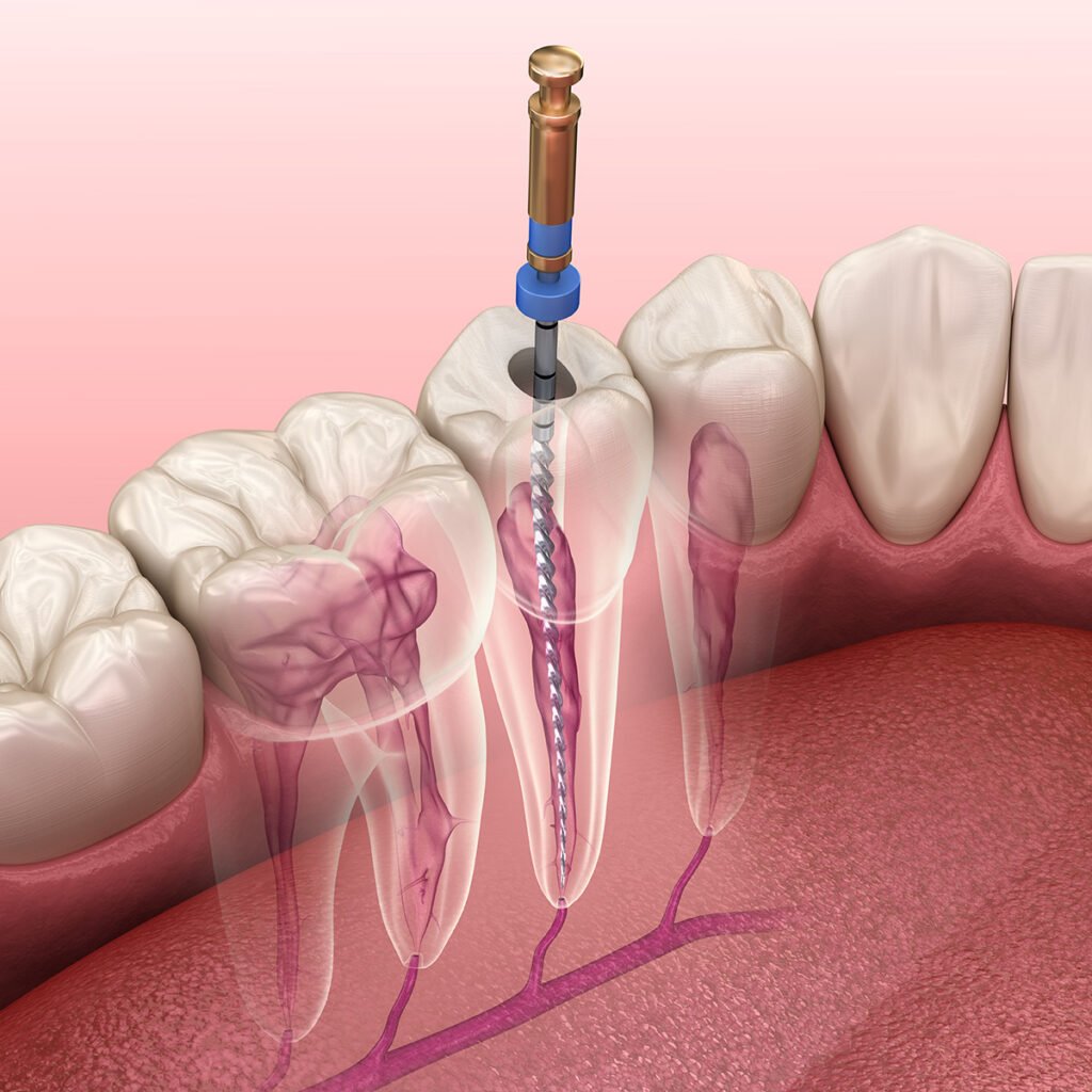 Root canal restorative treatment