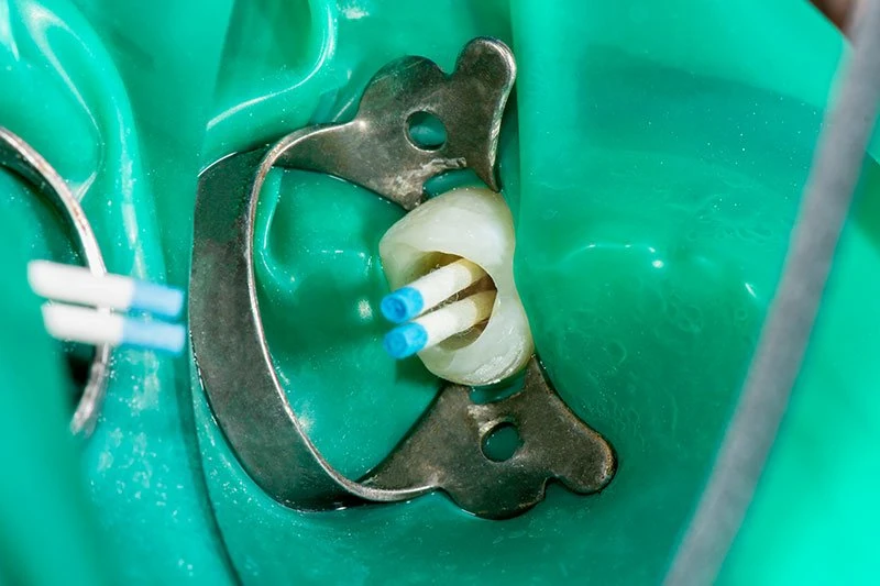 Root canal treated tooth illustration