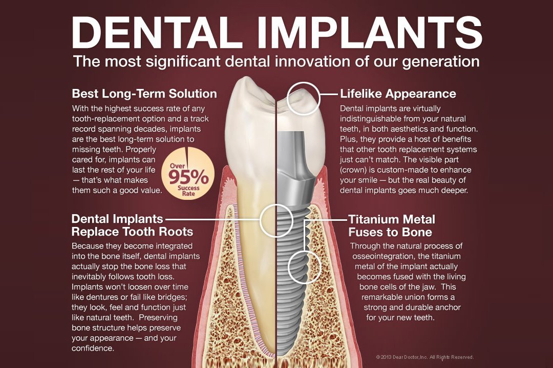 Dental implant treatment infographic