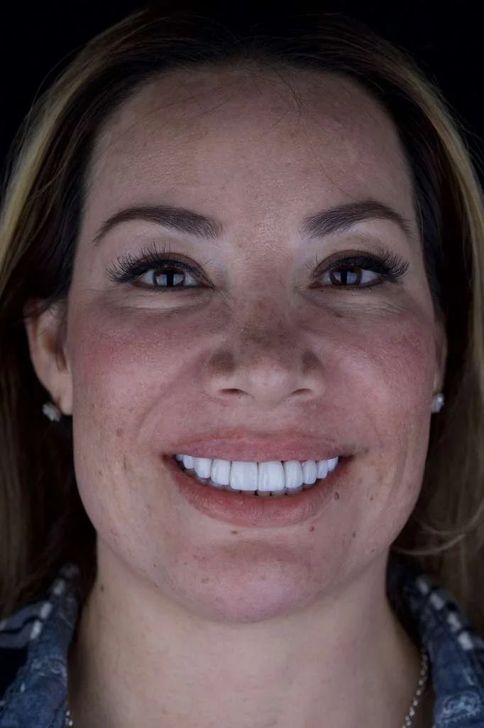 Dr. Borboa smile transformation 5