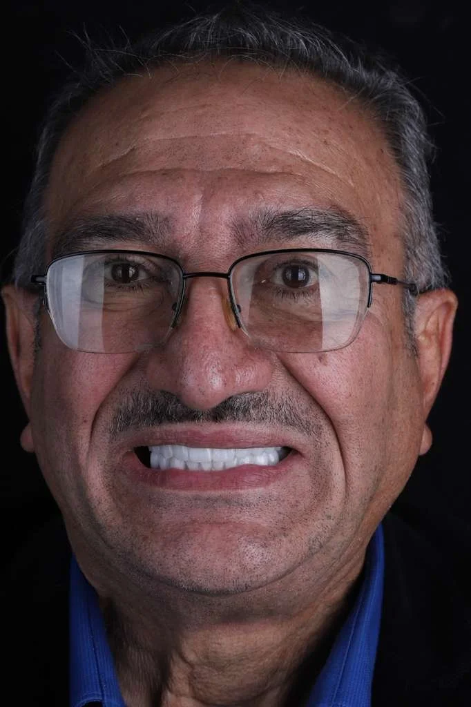 Dr. Borboa smile transformation 6