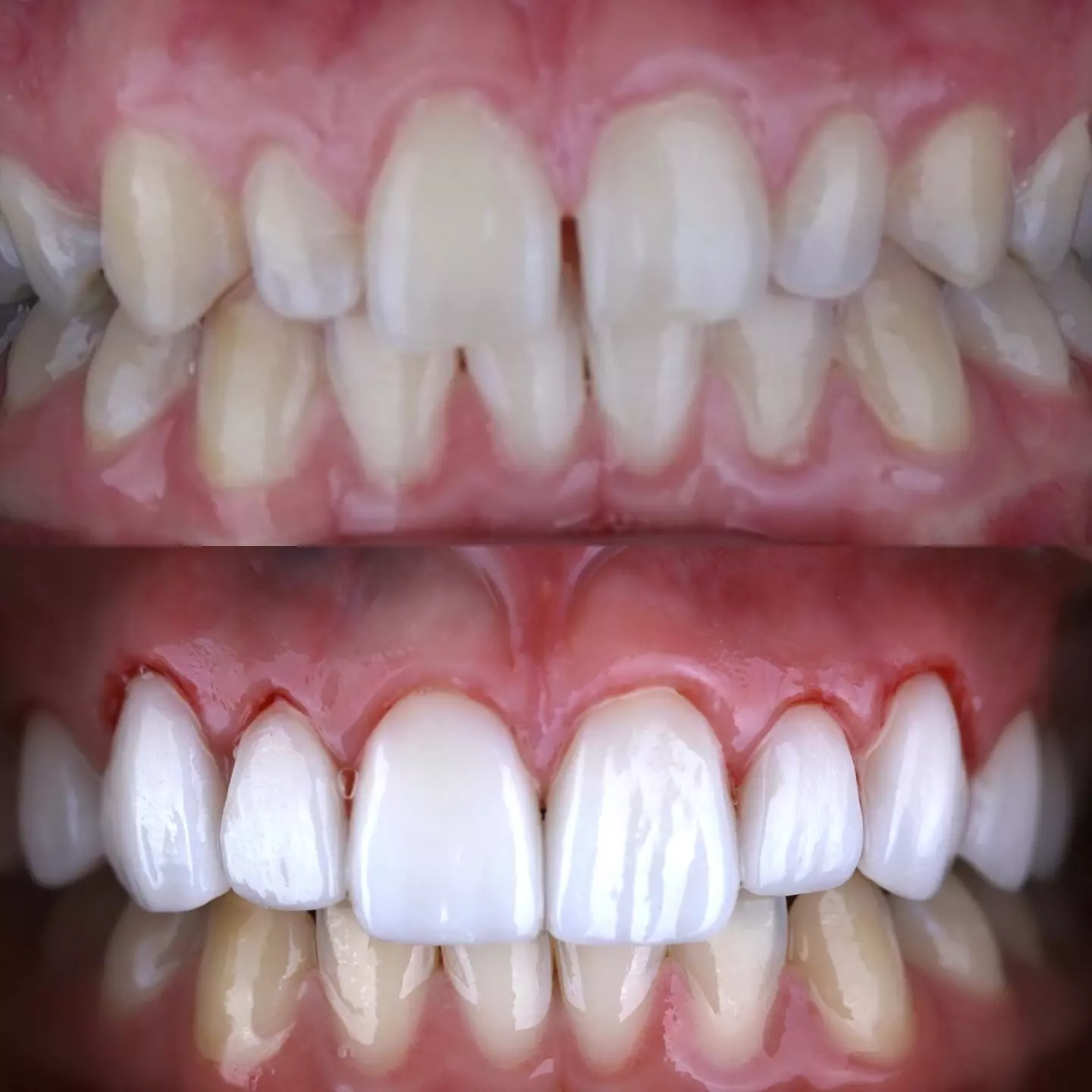 Dr. Borboa smile transformation 7