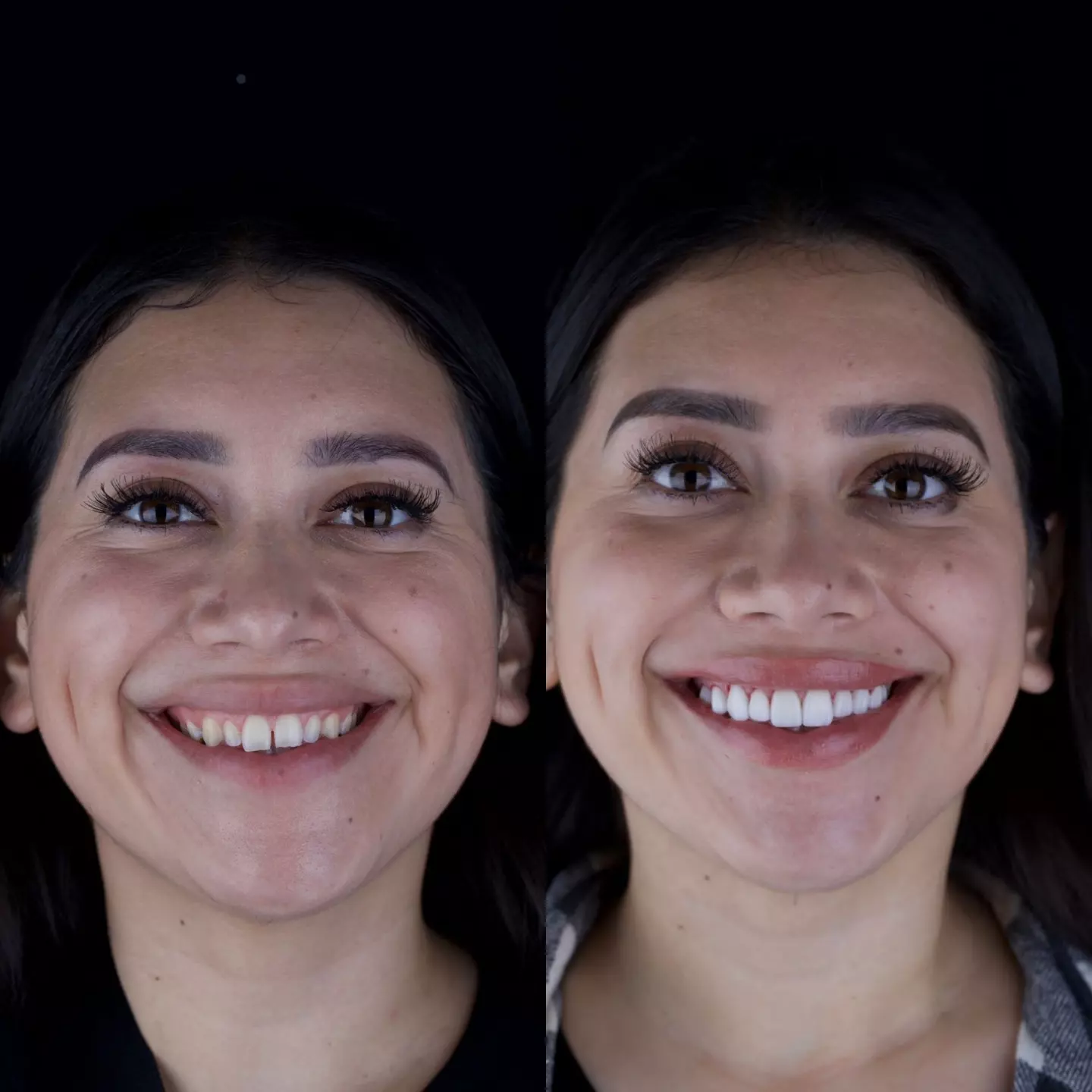 Dr. Borboa smile transformation 8