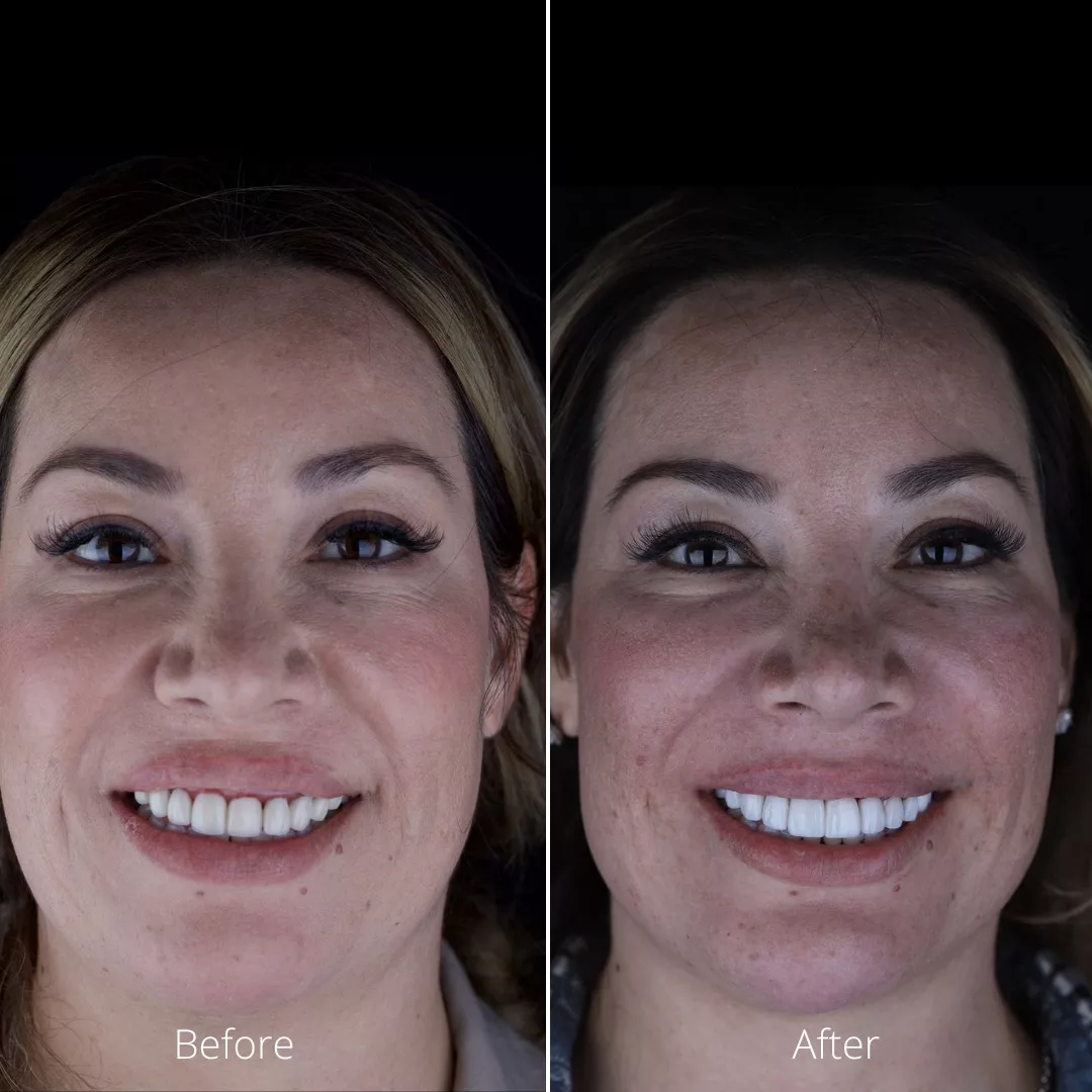Dr. Borboa smile transformation 10
