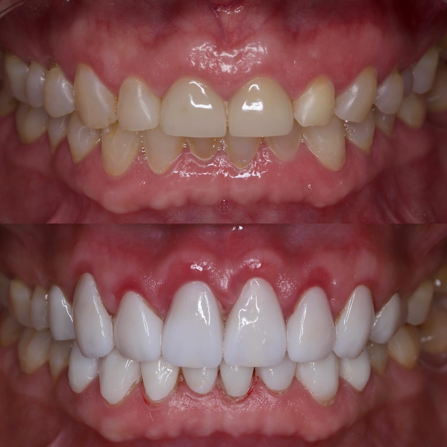 Dr. Borboa smile transformation 11
