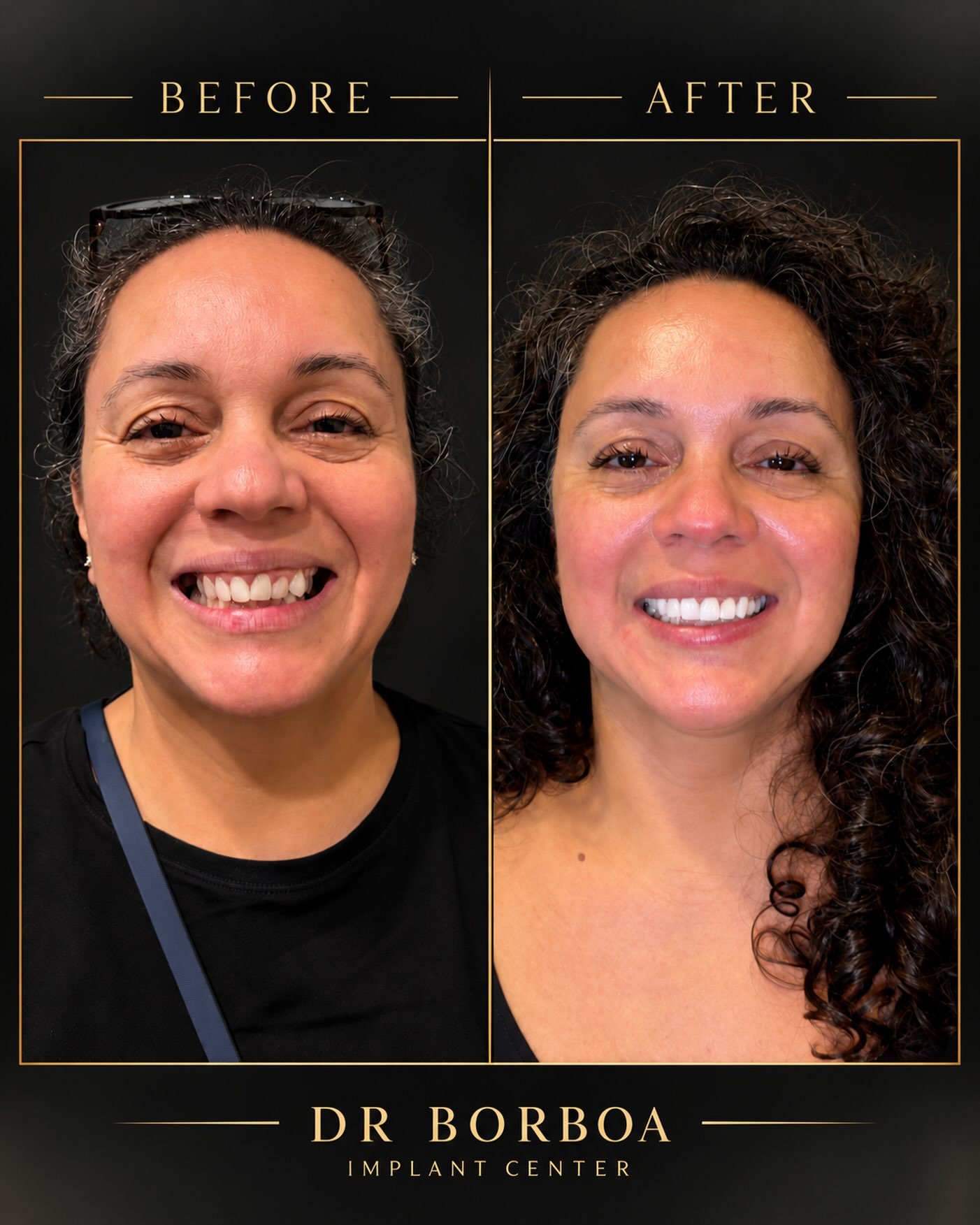 Dr. Borboa smile transformation 12
