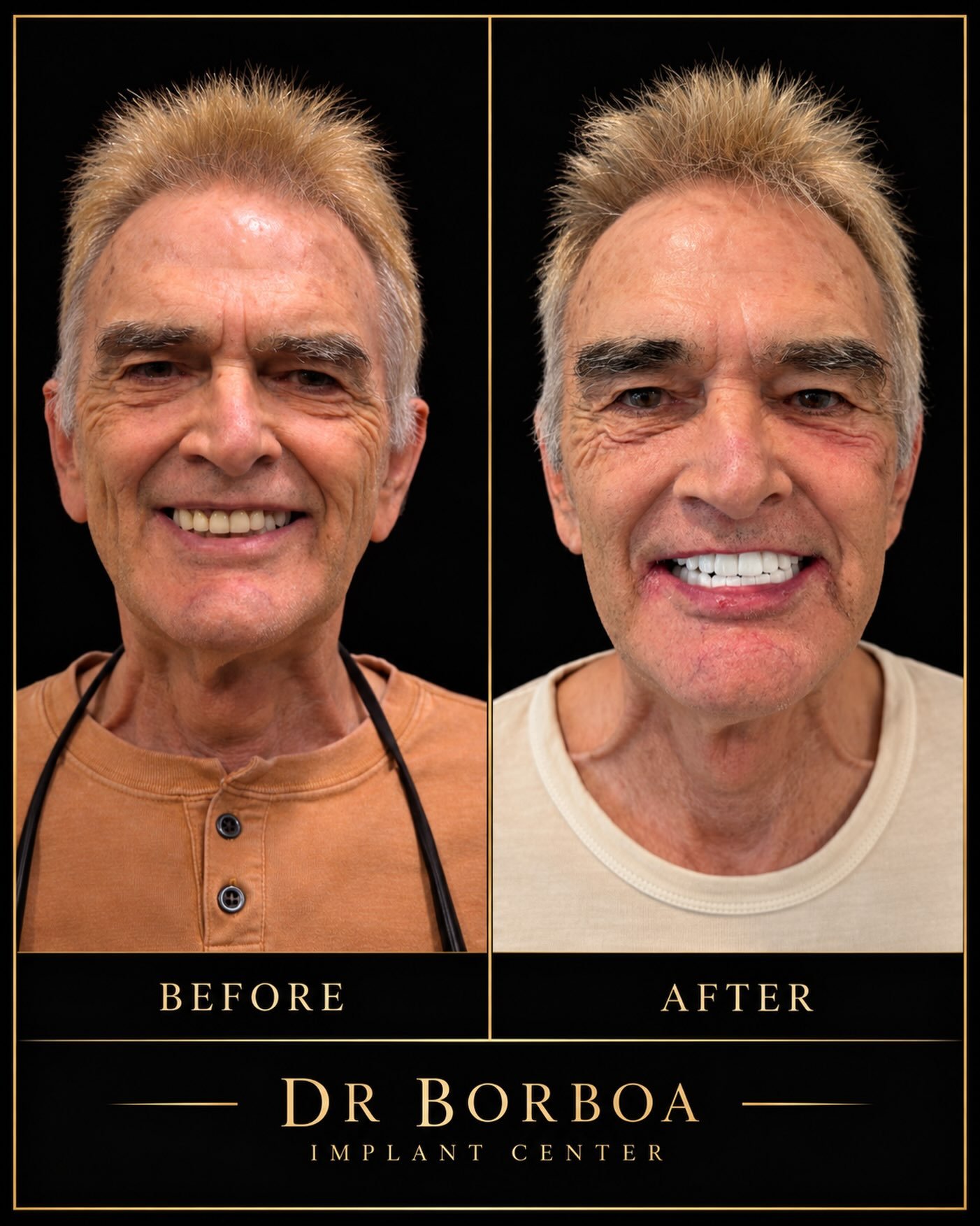 Dr. Borboa smile transformation 13